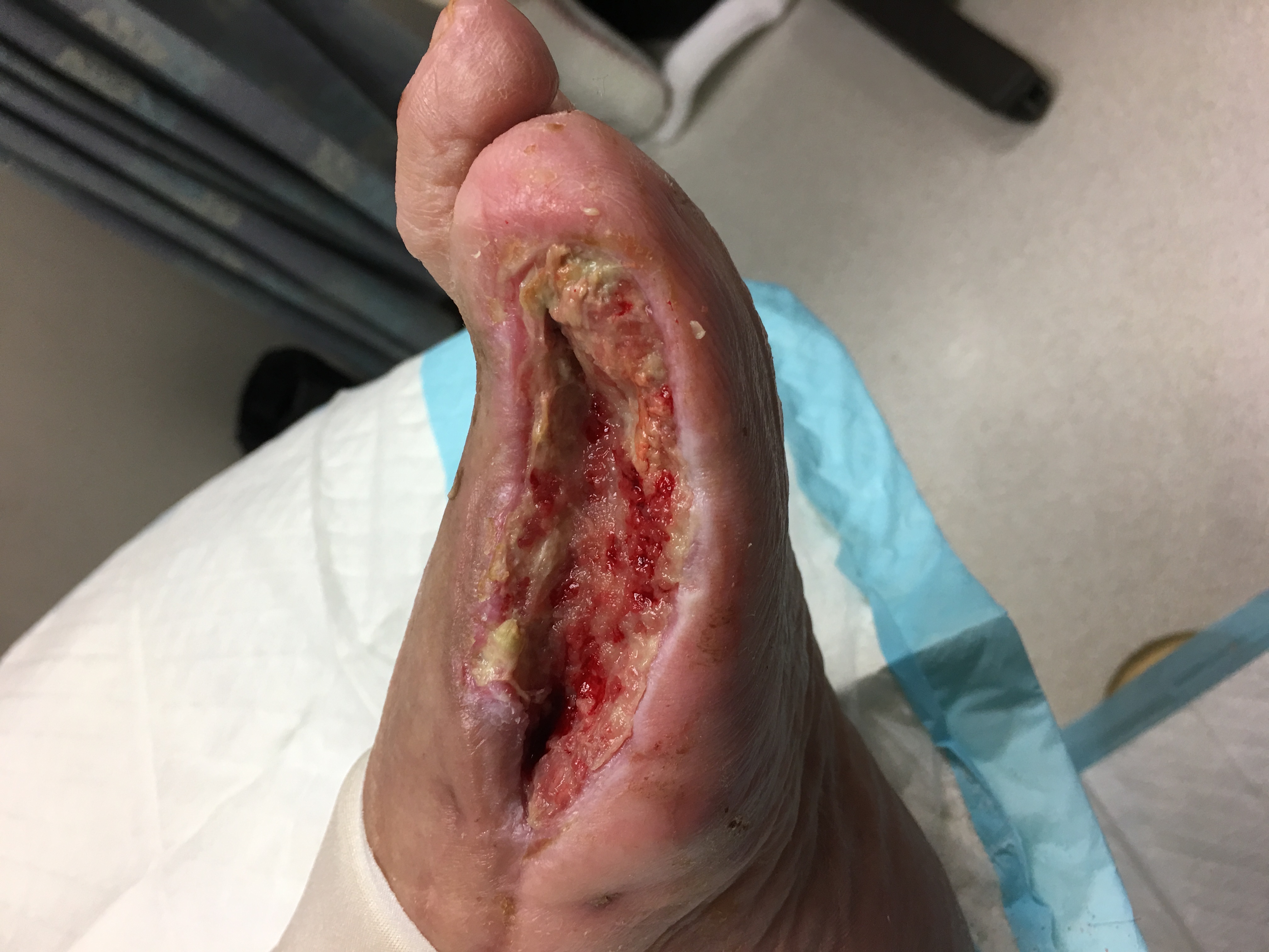 Surgical wound early healing stage